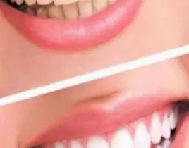 ürün Turko- Diş Temizleme Toprağı, Dişlerin Arasına Girer Dişlerin Üzerin’de ve Etrafında’ki Kireçleri ve Bakterileri Yok Eder Kalsiyum Emilimini Artırır Kemik Erimesini Durdurur Eklem ve Bileşenleri Güçlendirir Vücuttaki Diğer Mineralleri Dengeler Diş Çürümes